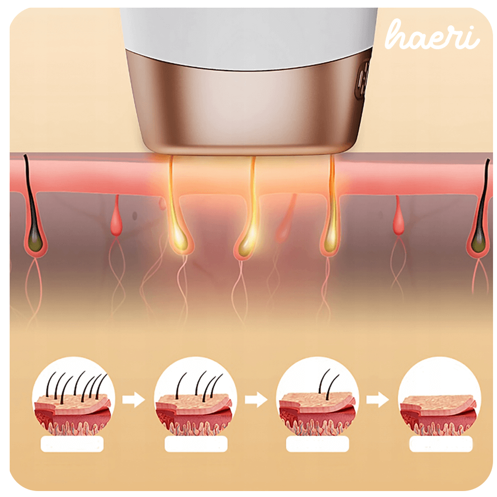 Illustration showing IPL laser epilator for hair removal process on skin, with before and after effects.